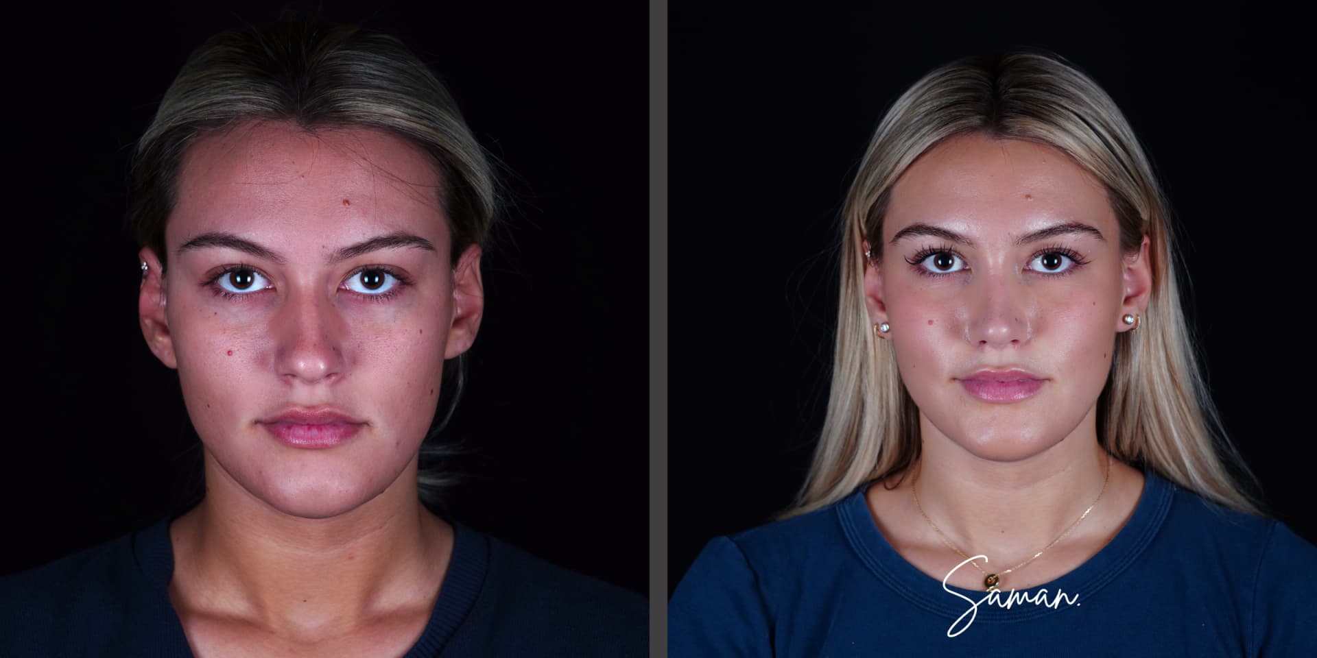Ultrasonic Preservation Rhinoplasty result — Saman MD, New York