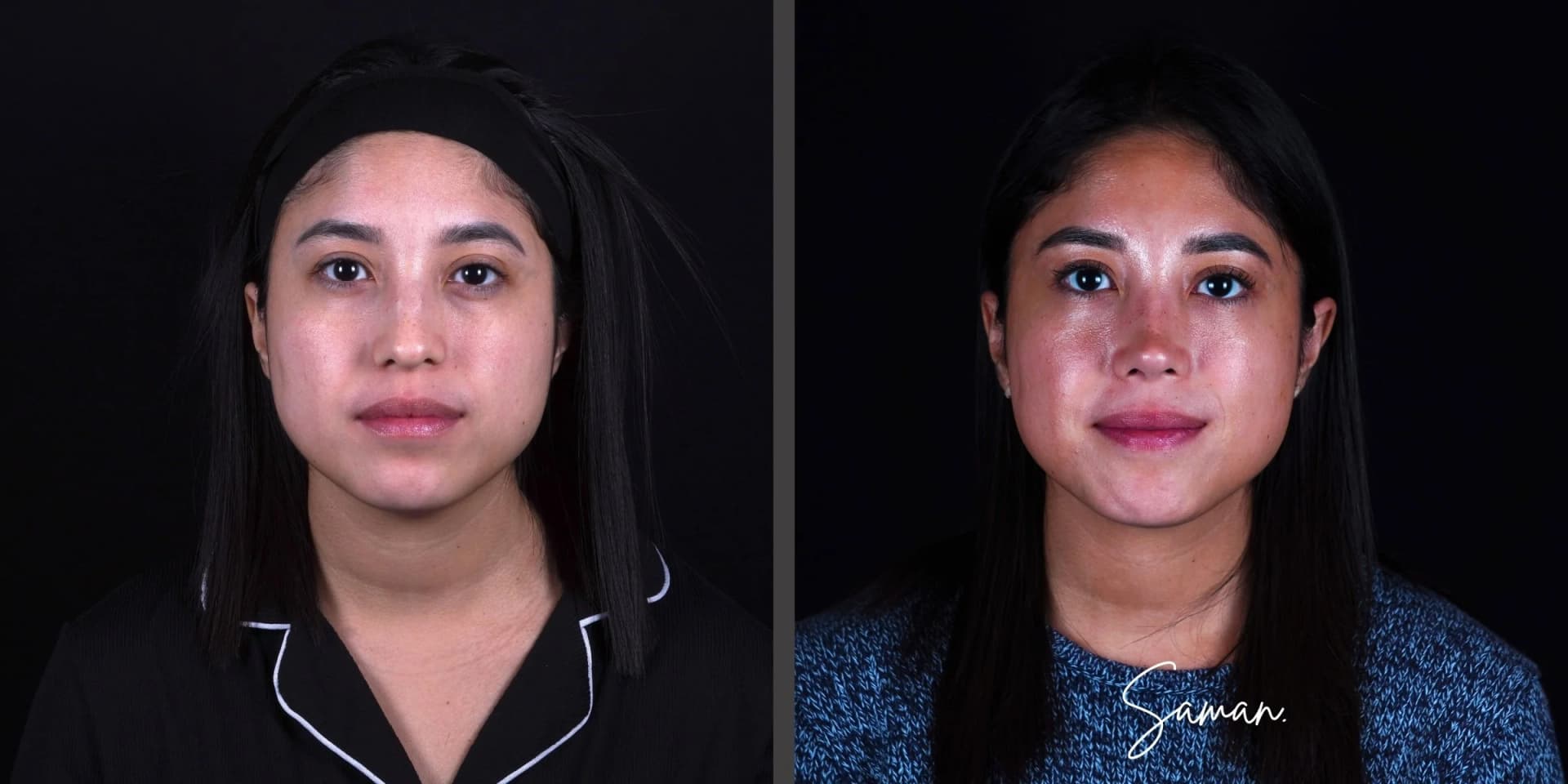 Preservation Rhinoplasty before-and-after result — Saman MD, New York