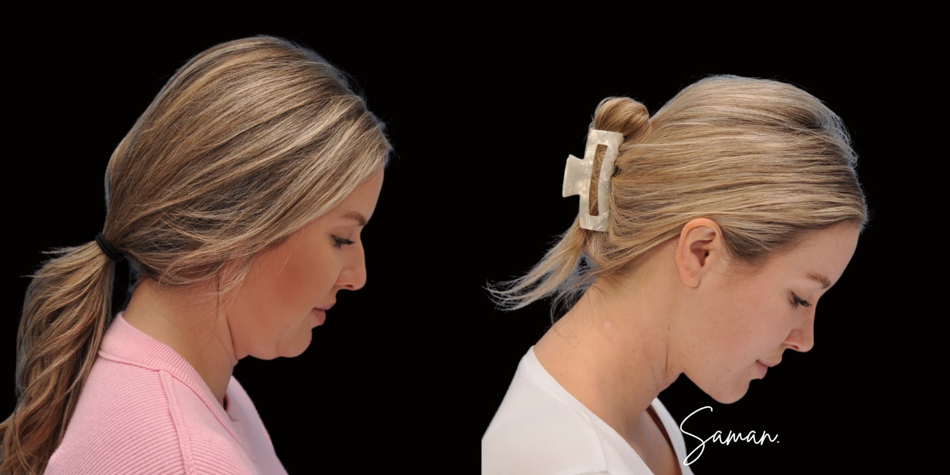 Rhinoplasty + Deep Neck Lift before-and-after result — Saman MD, New York