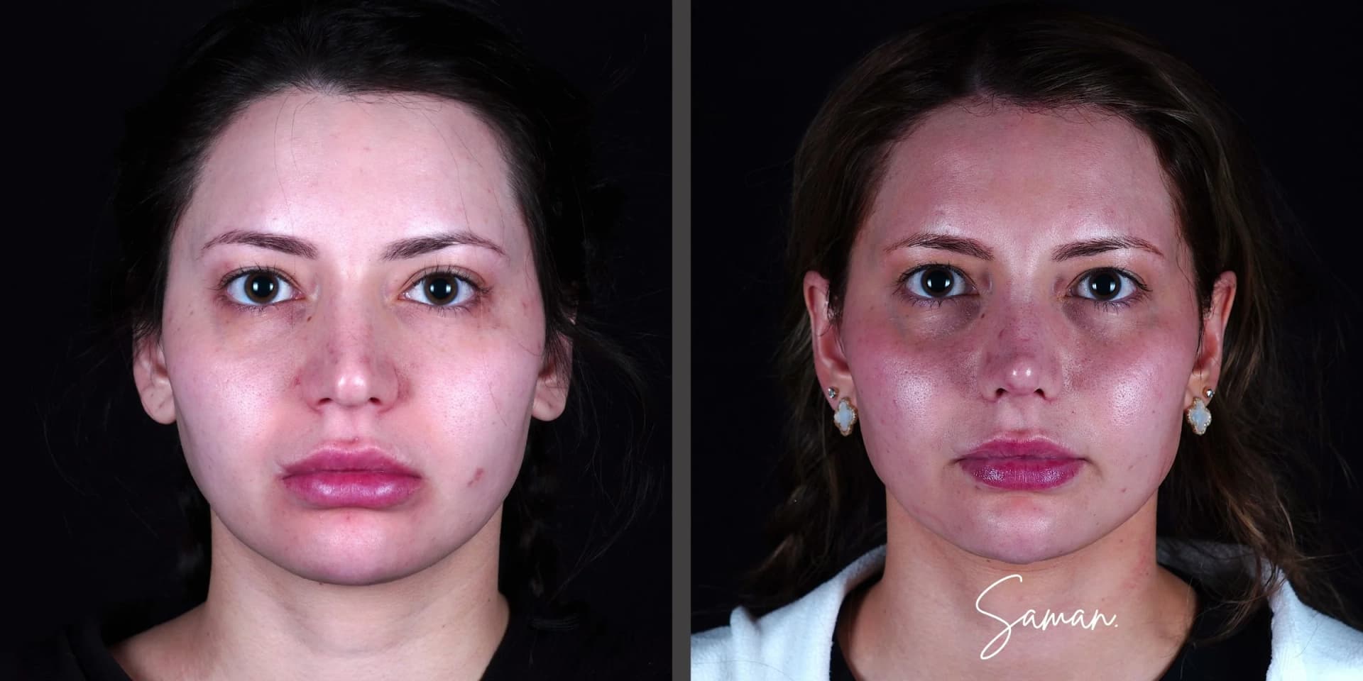 Revision Rhinoplasty result — Saman MD, New York
