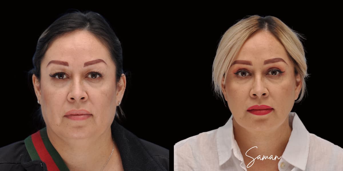 Full Facial Rejuvenation before-and-after result — Saman MD, New York