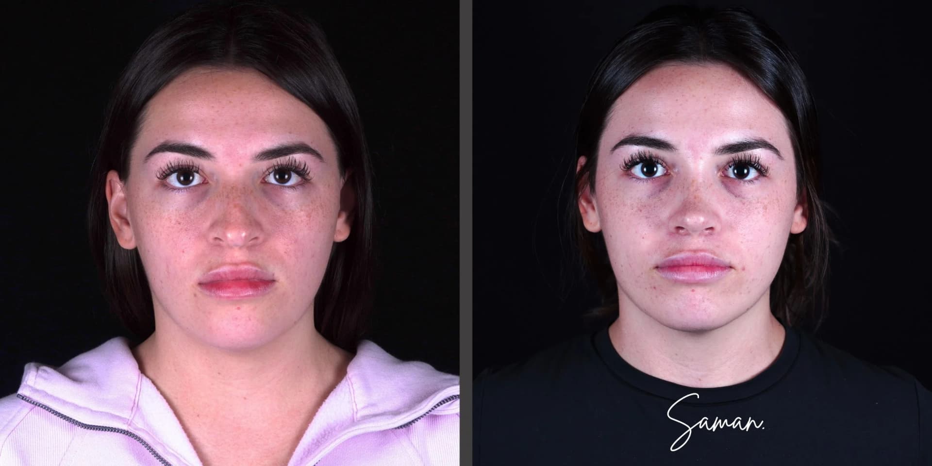 Ultrasonic Rhinoplasty result — Saman MD, New York