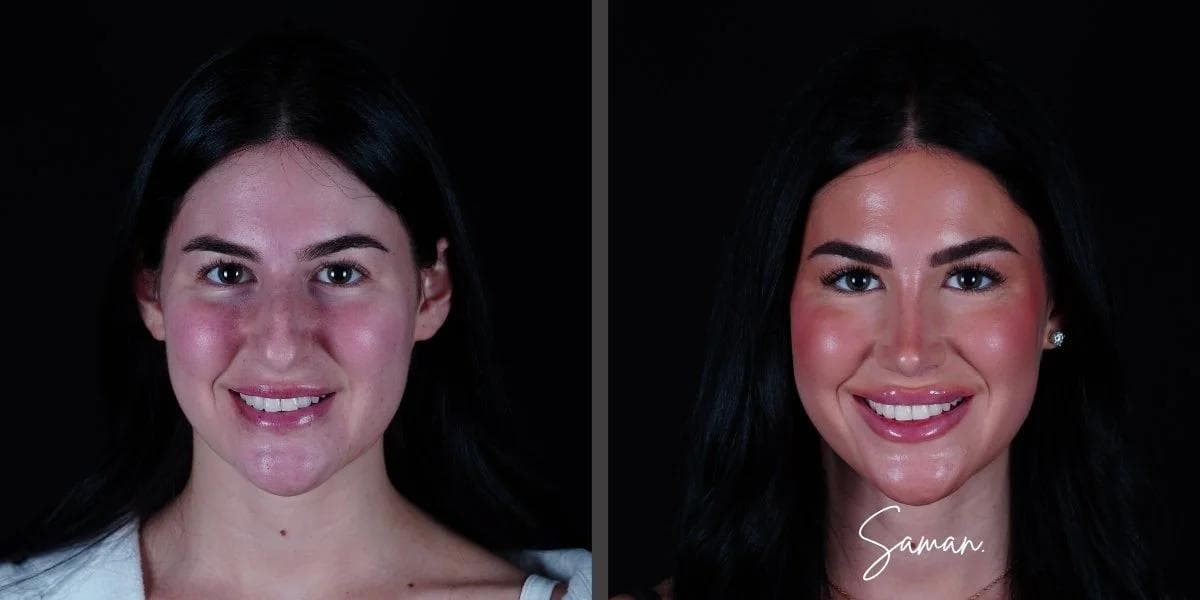 Rhinoplasty + Lip Lift result — Saman MD, New York